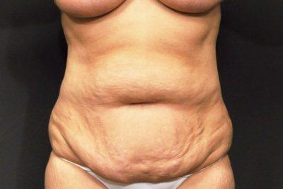 Seattle Liposuction Surgery - Smart Lipo Body Contouring - Belred