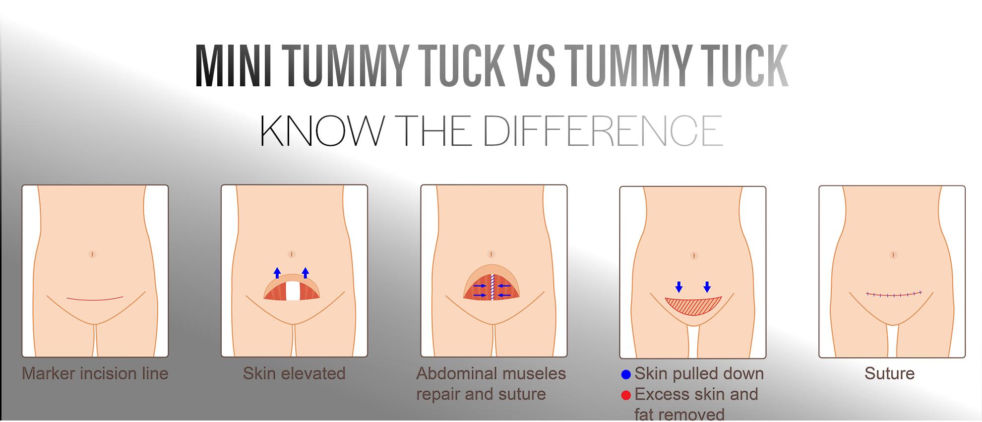 What is a Mini Tummy Tuck? - The Gallery of Cosmetic Surgery