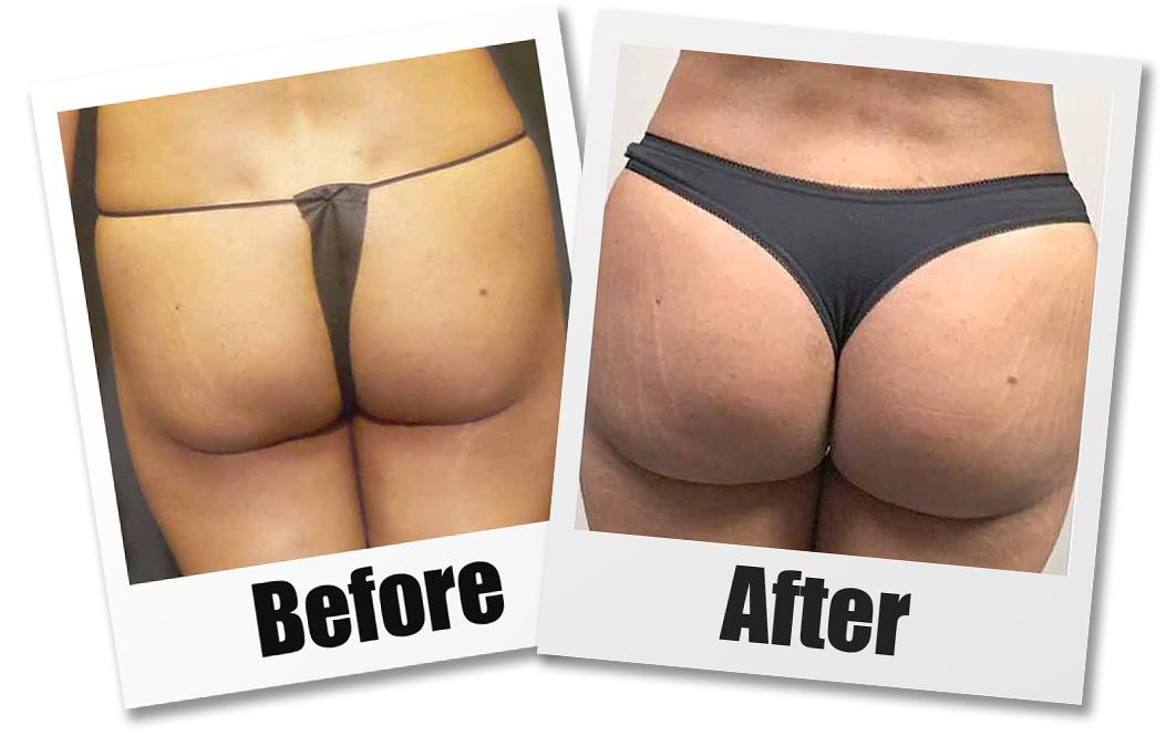 Liquid Butt Lift vs. Brazilian Butt Lift: Which One is Right for You?:  Sanctuary Cosmetic Center: Plastic Surgery