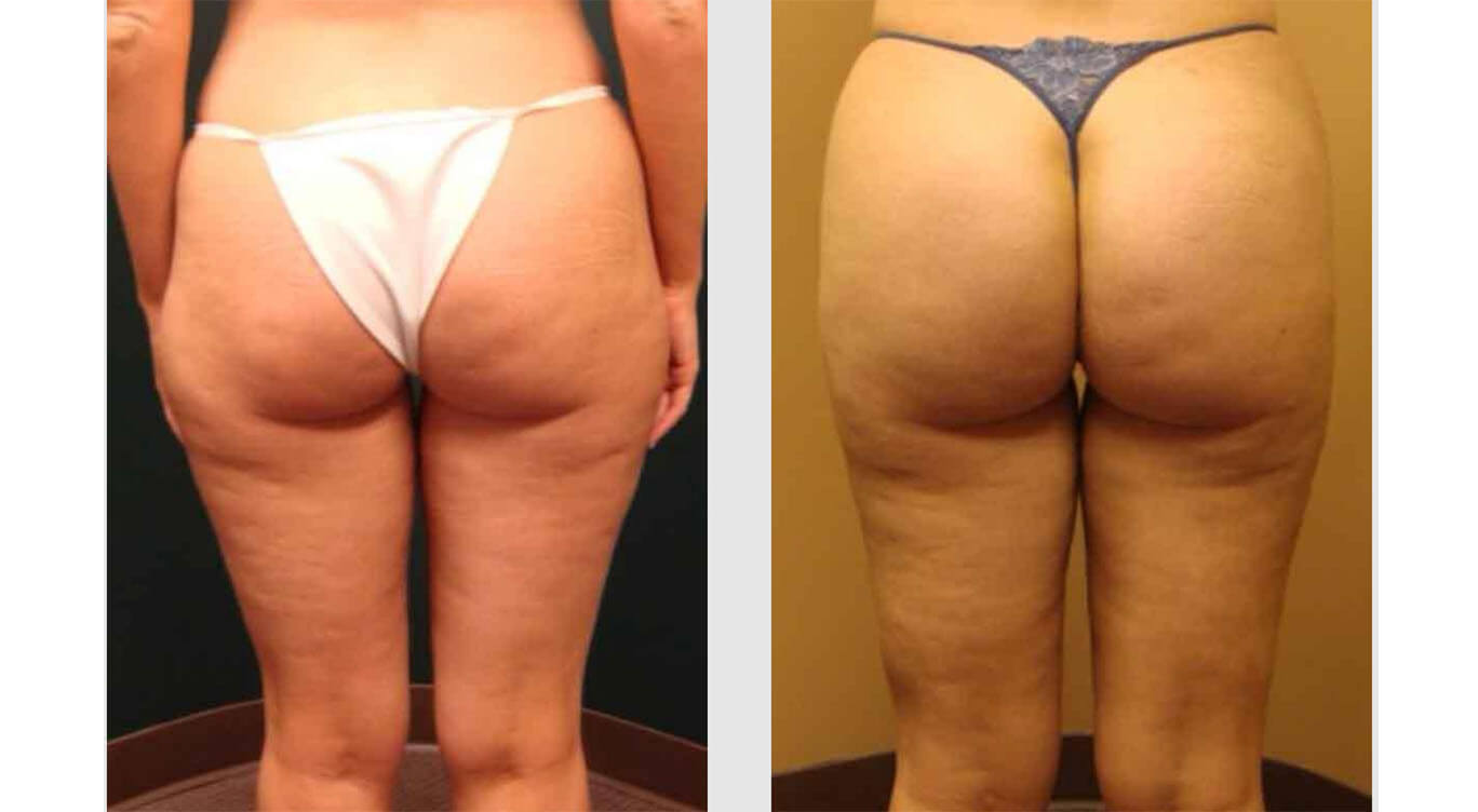 Hip Dips With Fat Transfer Treatment Beverly Hills CA