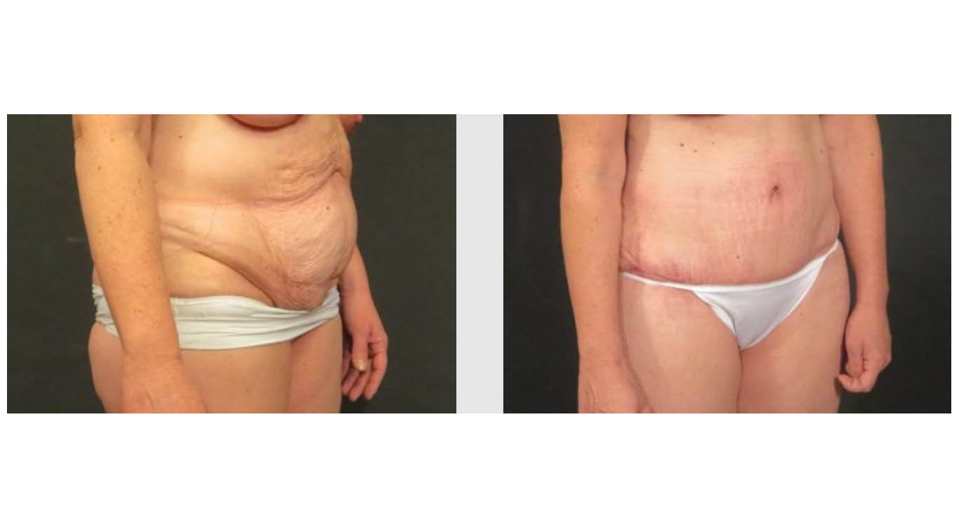 Liposuction vs. Tummy Tucks - Rotemberg Plastic Surgery