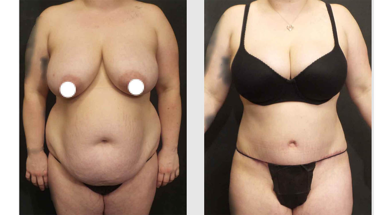 Reverse Tummy Tuck for Breast Volume - My Breast Cancer Doc