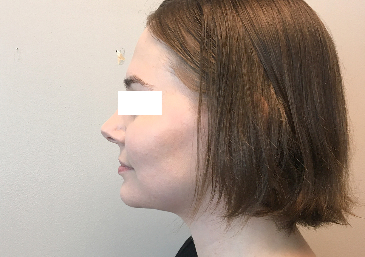 Facial Liposuction Case Before After Chin Lipo Photos